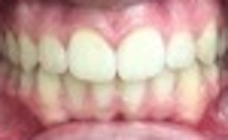 Patient 1 after picture Patient 1 after picture