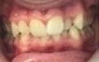 Patient 1 before picture Patient 1 before picture